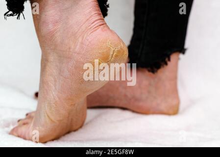 Suole di piedi asciutte e fessurate. Piedi Womans con tacchi asciutti, cracked skin.White sfondo morbido. Foto Stock