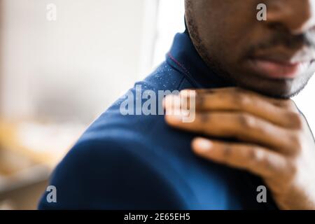 Uomo spazzolando Dandruff da vestito sporco. Prurito alla testa e ai capelli Foto Stock