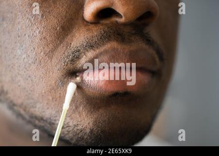 Trattamento delle labbra di Herpes Sore sul viso maschile Foto Stock