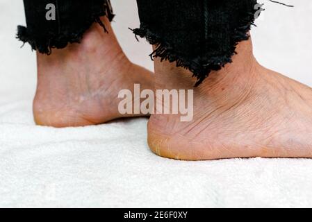 Suole di piedi asciutte e fessurate. Piedi Womans con tacchi asciutti, cracked skin.White sfondo morbido. Foto Stock
