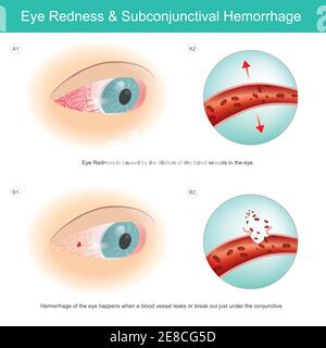 Arrossamento oculare ed emorragia subcongiuntivale. Il rossore dell'occhio è causato dalla dilatazione di piccoli vasi sanguigni nell'occhio e si verifica emorragia dell'occhio Illustrazione Vettoriale