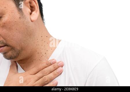 Chiuso il Skin Tags o Acrochordon sul collo uomo isolato su sfondo bianco. Concetto di assistenza sanitaria Foto Stock