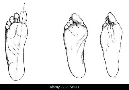 Piede sano (si allontana) e malato (diritti). Il piede si è aggraffato a causa di calzature scadenti. Illustrazione del 19 ° secolo. Germania. Sfondo bianco. Foto Stock