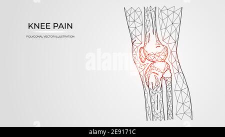 Immagine vettoriale poligonale di dolore, infiammazione o lesione nella vista laterale del ginocchio. Anatomia delle ossa delle gambe umane. Modelli di malattie ortopediche mediche Illustrazione Vettoriale