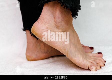 Suole di piedi asciutte e fessurate. Piedi Womans con tacchi asciutti, cracked skin.White sfondo morbido. Foto Stock