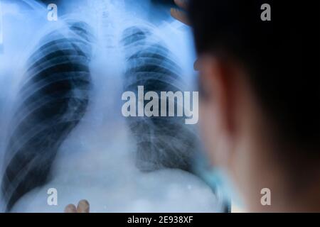 Una pneumologa femminile tiene in mano una scansione polmonare. Foto Stock