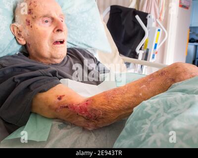 Il novantacinque anni ha il braccio ferito bendato A casa sua da un nurse.He distretto in visita non è in grado lasciare il letto o la casa a causa della fragilità Foto Stock