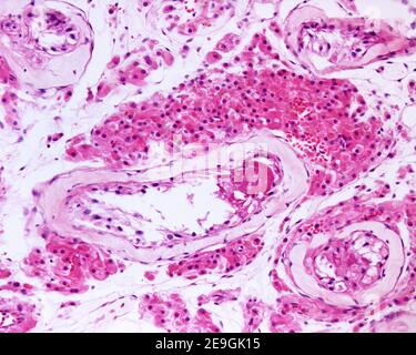 Ampio gruppo di cellule di Leydig in un caso di sindrome di Klinefelter, caratterizzato da un cariotipo 47, XXY. L'iperplasia dell'interstizio testicolare Foto Stock