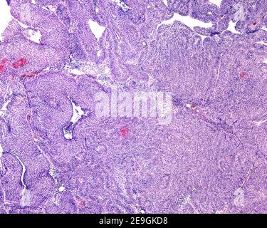 Immagine microscopica che mostra un papilloma della vescica urinaria formato da papille con nucleo fibrovascolare e rivestito con epitelio di transizione (uroteliale). Foto Stock