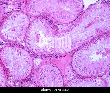 Testicolo in un caso di sindrome da sola cellula di Sertoli o aplasia delle cellule germinali. I tubuli seminiferi mostrano solo cellule di Sertoli. Foto Stock