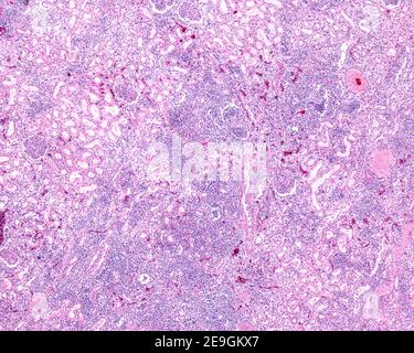 Micrografia a basso ingrandimento che mostra un rene affetto da una pielonefrite cronica. Gli infiltrati diffusi di cellule infiammatorie croniche occupano gran parte del t Foto Stock