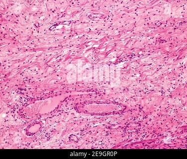 Esempio di un tipico tessuto connettivo sciolto appartenente alla sottomucosa dello stomaco. Fibre di collagene, cellule del tessuto connettivo e diversi ves del sangue Foto Stock