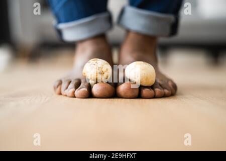 Piedi funghi fungo tra Toenail. Funghi del piede Foto Stock
