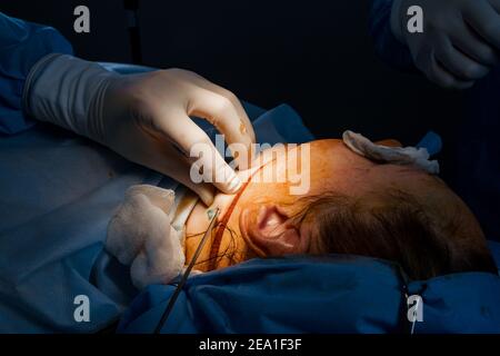 Liposuzione della chirurgia del mento. Pompando fuori il grasso nella zona del mento di una donna. Correzione della forma della faccia. Procedure di cosmetologia per persone anziane Foto Stock