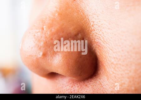 Donna grandi pori hanno greckles guancia oleosa, acne pimple sul naso Foto Stock