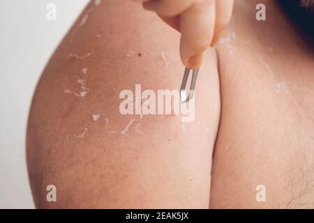 Peeling pelle a schiena e spalle effetto scottature sul corpo del giovane uomo dal bagno di sole in estate. Concetto pericoloso scottature solari Foto Stock