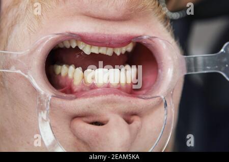 Dilatatore per la cavità orale. Preparazione della cavità orale del paziente per l'installazione dei rinforzi. Foto macro. Persona irriconoscibile. Concetto di assistenza sanitaria. Foto Stock