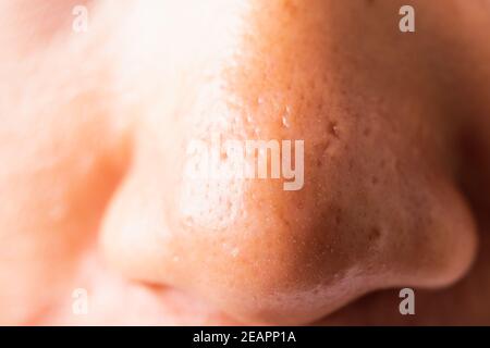 Donna grandi pori hanno greckles guancia oleosa, acne pimple sul naso Foto Stock