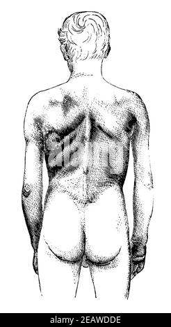 Paralisi muscolare del corpo superiore di un lavoratore a causa di avvelenamento cronico del piombo. Vista posteriore. Illustrazione del 19 ° secolo. Germania. Sfondo bianco. Foto Stock