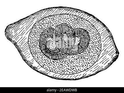 Capsula isolata di trichinae (Trichinella spiralis). Illustrazione del 19 ° secolo. Germania. Sfondo bianco. Foto Stock