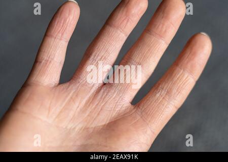 Cheratosi pilaris sulle mani causando pelle molto secca durante la stagione invernale. L'eczema della mano ha bisogno di molta cura. Foto Stock