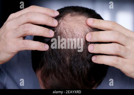 Calvizie, l'uomo preoccupato per la perdita dei capelli. Testa maschio con calvo Foto Stock