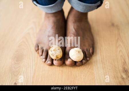 Piedi funghi fungo tra Toenail. Funghi del piede Foto Stock