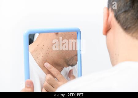 L'uomo medio asiatico guarda nello specchio e punta a Skin Tag o Acrochordon sul collo isolato su sfondo bianco. Concetto di assistenza sanitaria Foto Stock