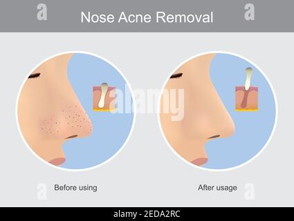 Rimozione del naso Acne. Illustrazione mostra la pelle umana nel caso prima di utilizzare e dopo l'uso un prodotto per il naso acne (blackhead) rimuovere. Illustrazione Vettoriale