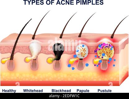 Pelle colorata acne anatomia composizione con tipi di acne pimples illustrazione vettoriale prima e dopo Illustrazione Vettoriale