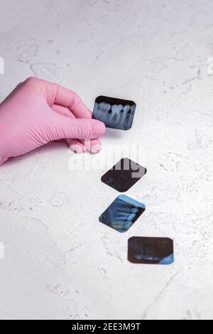 Medico che tiene e guarda le immagini radiografiche di foto dentali su la pellicola a raggi x rappresenta le radici dei denti di il gruppo di masticazione viene sigillato dopo l'endodone Foto Stock