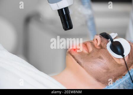 Primo piano di pelatura laser della pelle del viso. Girl facendo procedura di pallina di carbonio. Foto Stock