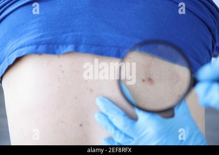 Il medico esamina la schiena del paziente con le talpe attraverso la lente di ingrandimento Foto Stock