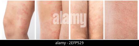 Panel Collage informazioni sulla dermatite atopica acuta sulle gambe di un bambino è una malattia dermatologica della pelle. Eruzione cutanea grande, rossa, infiammata e scalata sulle lle Foto Stock