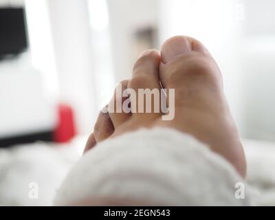 le dita dei piedi gonfie e lividi si avvicinano Foto Stock