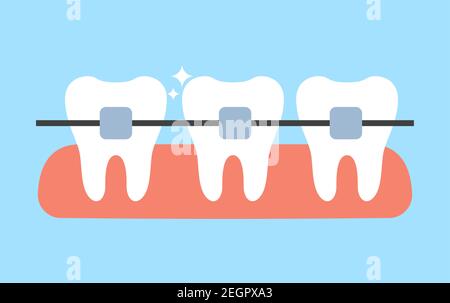 Denti bianchi con bretelle dentali vettoriali illustrazione piatta. Allineamento del morso dei denti. Servizio di clinica odontoiatrica, odontologia cosmetica, raddrizzatura dei denti e concetto di procedure ortodontiche. Illustrazione Vettoriale