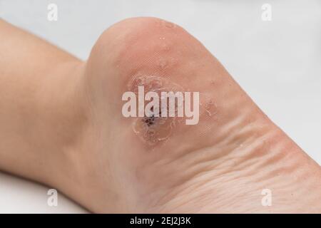 Verruca plantare vicino sul fondo del tallone del piede causato dal papillomavirus umano, o HPV. Foto Stock