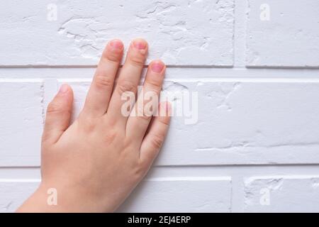 Verruca comune Verruca vulgaris una verruca piatta per mano di bambini e adulti. Essi sono causati da un tipo di papillomavirus umano HPV. Trattamento verruche Foto Stock