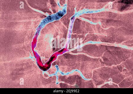 Infarto miocardico con un trombo significativo Foto Stock