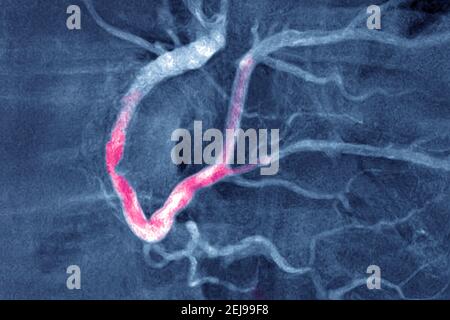 Infarto miocardico con un trombo significativo Foto Stock