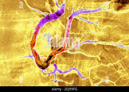 Infarto miocardico con un trombo significativo Foto Stock