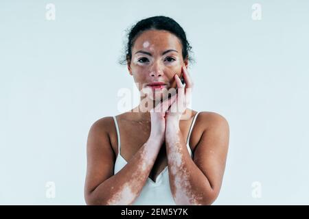 Bella donna con pelle di vitiligo in posa in studio. Concetto di positività del corpo e di autoaccettazione Foto Stock