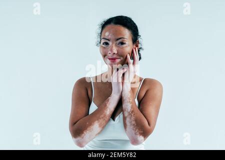 Bella donna con pelle di vitiligo in posa in studio. Concetto di positività del corpo e di autoaccettazione Foto Stock