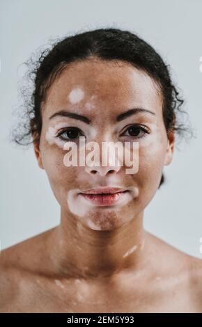 Bella donna con pelle di vitiligo in posa in studio. Concetto di positività del corpo e di autoaccettazione Foto Stock