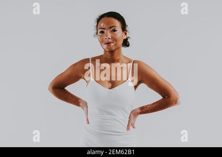 Bella donna con pelle di vitiligo in posa in studio. Concetto di positività del corpo e di autoaccettazione Foto Stock