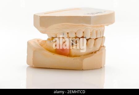 Insieme di immagini con un getto parziale di dentiera e dentiera che mostra i giochi dei denti mancanti su uno sfondo bianco con il riflesso. Foto Stock