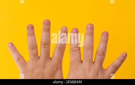 Primo piano le dita maschili con unghie morse, gangolate, masticate o brutto, un po 'cattivo chiodo e isolato su uno sfondo giallo Foto Stock