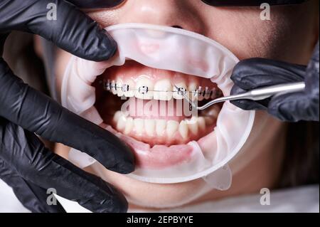 Primo piano vista sulle mani del dentista in guanti neri togliendo le vecchie fasce in gomma nera dalle bretelle in ceramica con l'aiuto di un gancio dentale per sostituire il filo arrugginito che collega le bretelle. Concetto di odontoiatria Foto Stock