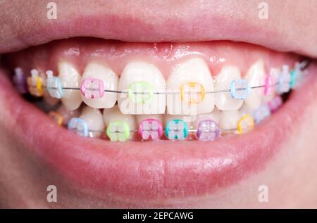 Immagine in primo piano orizzontale del sorriso della bella donna, che mostra denti bianchi sani con staffe in ceramica, uniti a fili e colorati fasce in gomma. Vista frontale. Concetto di accessori ortodontici Foto Stock