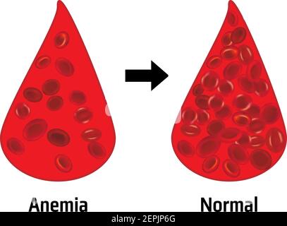 Anemia e normale montaggio dei globuli rossi Illustrazione Vettoriale